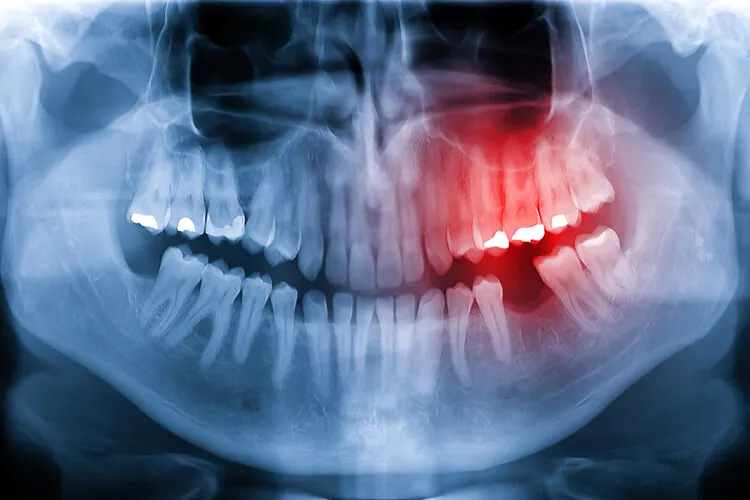 Röntgenbild zeigt entzündete Zahnwurzeln