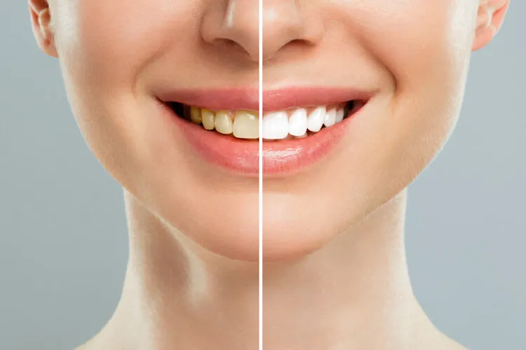 Vorher/Nachher Bild einer professionellen Zahnaufhellung